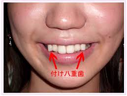 Did your kid get ready for vampire theme parties. In Japan A Trend To Make Straight Teeth Crooked Noticed The New York Times