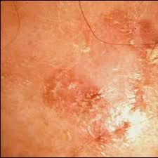 Pin On Skin Cancer
