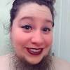 Hirsutism is often caused by a simple hormonal imbalance. 1