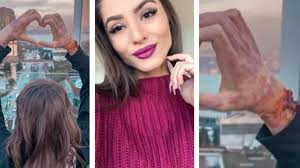 Nonstop na praze 3 je otevřen! Tynus Tresnickova Poprve Od Nehody Ukazala Oblicej Popalena Youtuberka Podstoupila Operaci Extra Cz