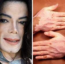 The vitiligo global issues consensus conference. Weissfleckkrankheit Vitiligo Wenn Die Haut Fleckenweise Verblasst Welt