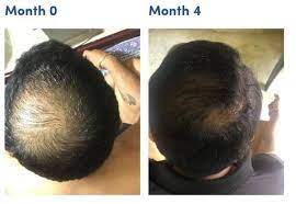 After an initial shedding phase (~ 2 weeks), new hair growth should occur. Minoxidil Shedding Increased Hair Fall In First Month Of Using Minoxidil
