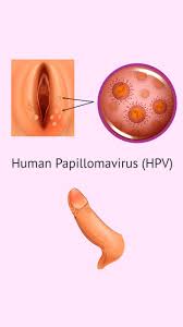 Image result for human papillomavirus symptoms