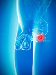It turns out that the prostate is expendable; What Does The Prostate Do Can You Live Without It And What Happens When You Have It Removed