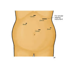 Although many parameters as regards the outcome of gastric sleeve depend on the competency of the surgeon, the probability of your stomach getting stretched after the surgery ultimately rest on your shoulder. Gastric Bypass Surgery Abeezar Sarela Leeds