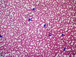La mononucleosi è una malattia infettiva che si trasmette attraverso la saliva; Mononucleosi Infettiva Wikipedia
