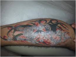 They do give temporary tattoos but, they do not give permanent. Medical Complications Of Tattoos A Comprehensive Review Springerlink