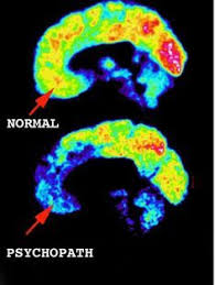 Life As A Nonviolent Psychopath Psychopath Brain Scan Psychology Facts