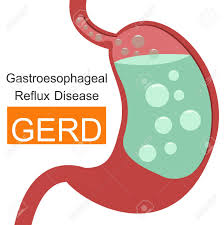 We did not find results for: Gastroesophageal Reflux Disease Gerd Infographic Royalty Free Cliparts Vectors And Stock Illustration Image 76883582