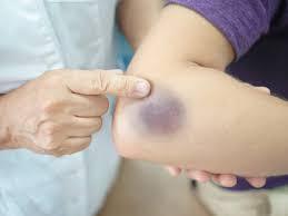 This they do by preventing further leaking of blood to the area. Bruise Home Remedies Or Treatments How To Cure Bruises At Home