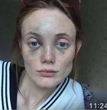 Kira Dice Shared Pics of Her Face After Alleged Assault by Boyfriend