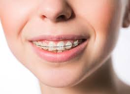 Few folks are more than this although it does happen. Overbite Correction Treatment How Long Does The Process Take
