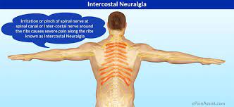 Superficial back muscles are the first layer of muscles below the skin and superficial fascia. Neuralgia Of Back