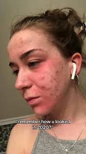 hormonal acne is a b!tch #fyp #foryou #foryoupage