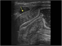 Symptoms include back and/or neck pain, and numbness, tingling and weakness in your arms and legs. Pediatrics 9 1 Pediatric Abdomen And Retroperitoneum Case 9 1 1 Hypertrophic Pyloric Stenosis Ultrasound Cases