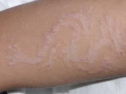 Natural henna only stains the skin orange, red or brown, and the length of time the henna sits on the skin before it is washed off will determine how dark the tattoo is and how long it will last. Bizarrely Shaped Allergic Contact Dermatitis After Temporary Henna Download Scientific Diagram