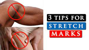 Whether they are on your shoulders, legs or buttocks, watch this video so th. How To Get Rid Of Stretch Marks On Your Shoulders Legs Stomach Youtube