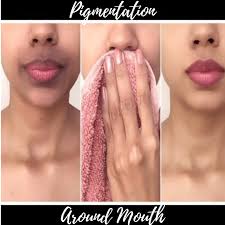 Causes And Remedies For Skin Pigmentation Around The Mouth Natural Hyperpigmentation Treatment Hyperpigmentation Treatment Lip Hyperpigmentation