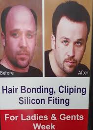 Our non surgical hair replacement systems and accessories are shipped to more than 180 countries. Hair Replacement Hair Wig In Ahmedabad Nikol By S Kumar Family Salon Id 21079418891