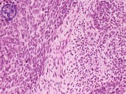 Image result for Nephroblastoma