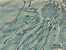 脳がカビに支配される 身体や口の中がカビだらけの人が急増中 治らない湿疹 過敏性腸症候群 歯周病 膣カンジタは内臓にはびこるカンジタ菌の仕業かもしれない カンジタ菌 菌 歯周病