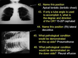 Segmental diagram of lung anatomy. Rdsc 233 Mid Term Review The Following Slides Highlight The Information Covered Through The Unit On The Colon 1 Terminology From The Units 2 Review Ppt Video Online Download