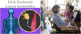 La ela es un tipo particular de la familia de enfermedades neuromusculares, que puede producir una parálisis muscular progresiva. Esclerosis Lateral Amiotrofica Ela Que Es Tipos Causas Sintomas Diagnostico Tratamiento Y Prevencion Arriba Salud