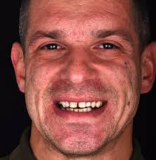 🤗Lepa transformacija za kraj nedelje... 🤩cirkonijumske krunuce premium  kvaliteta 🤩digitalni protokol