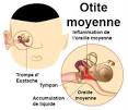 Symptomes otite