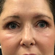Eyelid Surgery Nashville & Clarksville
