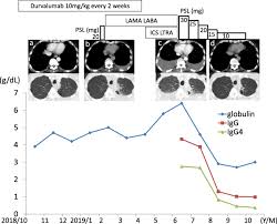 This video shows pleural effusion on both pleural cavities with lung tissue floating in the fluid. Igg4 Related Pleural Disease In A Patient With Pulmonary Adenocarcinoma Under Durvalumab Treatment A Case Report Bmc Pulmonary Medicine Full Text