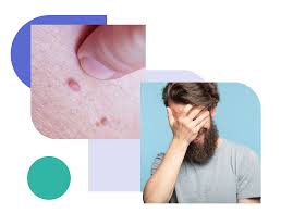 Image result for genital warts