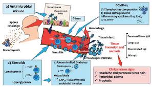 Rhino-orbital mucormycosis in a Mexican patient with COVID-19: Case report
