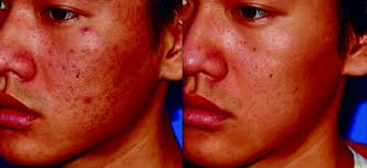 This typically takes around 30 to 45 minutes to complete. Eclipse Micropen Anna Avaliani Md Cosmetic Laser Surgery Anna Avaliani Md Cosmetic Laser Surgery