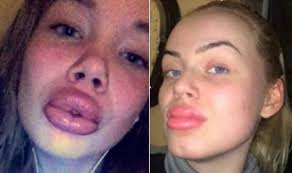 Bilderesultat for worst plastic surgery lips