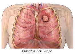 Lungenmetastasen Metastasen Lebenswerwartung Lunge Prognose