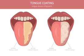 Image result for yellow tongue infection
