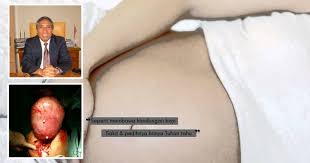 Penulisan ini telah disunting bagi memudahkan pembacaan. Bukan Kerana Hamil Perut Wanita Ini Membesar Kerana Fibroid Ketahui Punca Cara Menanganinya Nona