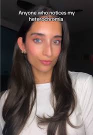 Exploring Heterochromia: The Beauty of Unique Eyes