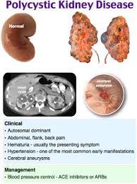 As discussed, parenchymal renal disease may refer to either unilateral (uncommon) or bilateral conditions. Polycystic Kidney Disease Flashcards Quizlet