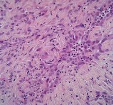 Adenocarcinoma cancers being usually in one of the following organs: Z Onglibilmbom