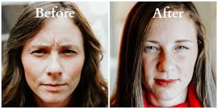 Before and After Using Dysport