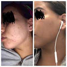 B A Only 3 Months On Minocycline Epiduo Forte And Good Skin Care Routine Best Skin Care Routine Good Skin Skin Care Routine