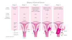 Cervical cancer can cause any number of physical symptoms depending on the stage and, if it has metastasized, where in your body it has spread. Cervical Cancers
