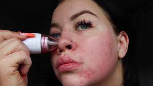 Nach einer microdermabrasion müssen sie zudem selbst einschätzen, in welchen zeitlichen abständen sie die behandlung wiederholen. Microdermabrasion Zuhause Review Pmd Youtube