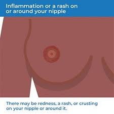Some common, early warning signs of breast cancer include: Breast Cancer Symptoms Health Information Bupa Uk