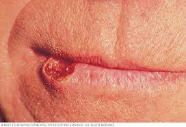 It usually appears as tumors on the skin or on mucosal surfaces such as inside the mouth, but these tumors can also start in other parts of the body. Lip Cancer Symptoms And Causes Mayo Clinic