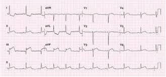Image result for Myocardial Infarction Stabilization