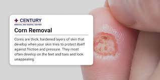 Image result for Corns