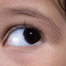 Nistagmus Nedir Ve Cesitleri Nelerdir Medicana